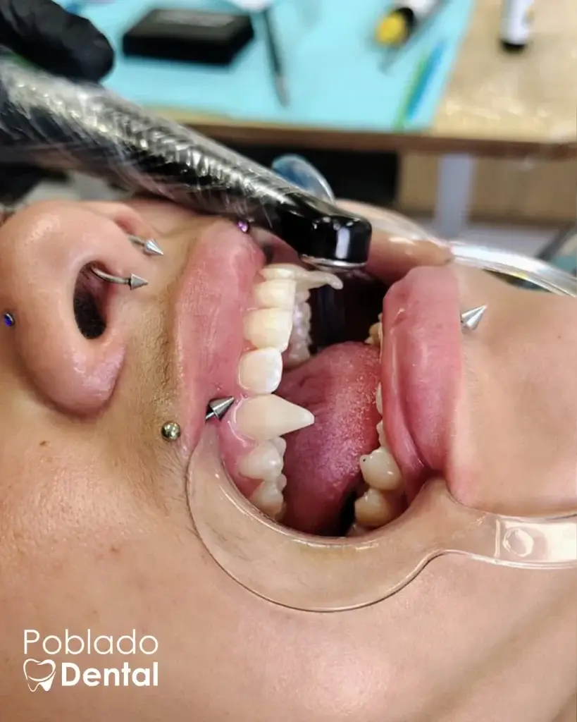 Colmillos de vampiro en resina hechos en Poblado Dental Medellín