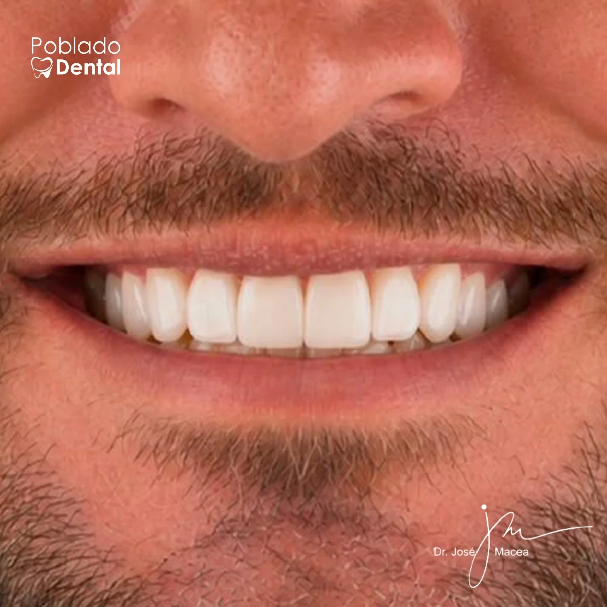 Resultado de diseño de sonrisa con carillas en resina, Dr. José Macea, Poblado Dental Medellín