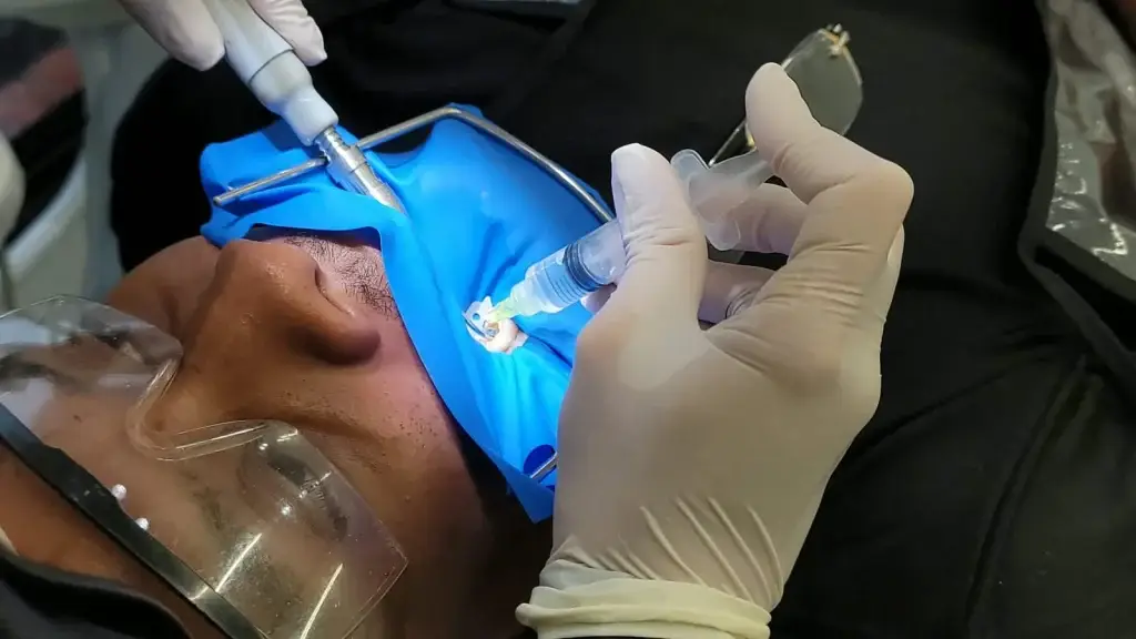 Root canal treatment in Medellín with a rubber dam at Poblado Dental